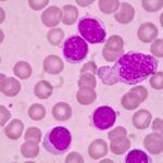 Zanubrutinib Shows Sustained Progression-Free Survival at Five Years