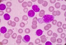 Zanubrutinib Shows Sustained Progression-Free Survival at Five Years