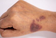 Eptacog Beta Relieves Pain in Patients with Hemophilia