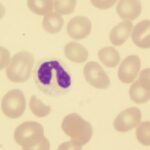 Study: Lower Educational Attainment Is Barrier to HCT for Patients with AML