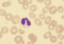 Study: Lower Educational Attainment Is Barrier to HCT for Patients with AML