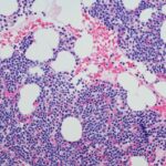 Daratumumab Monotherapy Delays Progression of High-Risk Smoldering Multiple Myeloma