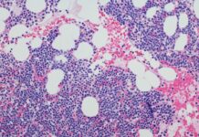 Daratumumab Monotherapy Delays Progression of High-Risk Smoldering Multiple Myeloma