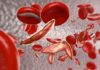 Study Shows Etavopivat Efficacy in Sickle Cell Disease