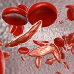 Trends and Issues in Fertility Preservation Among Patients with Sickle Cell Anemia