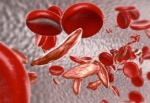 Trends and Issues in Fertility Preservation Among Patients with Sickle Cell Anemia