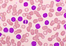 AMPLIFY Trial Reports Results of Acalabrutinib-Venetoclax in TN-CLL